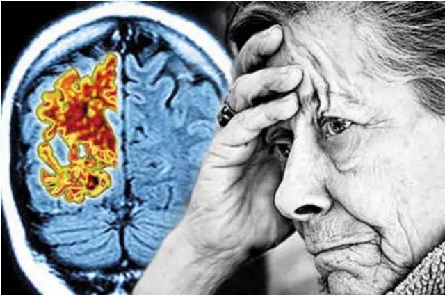 脑血管病：老年痴呆并发精神病的元凶
